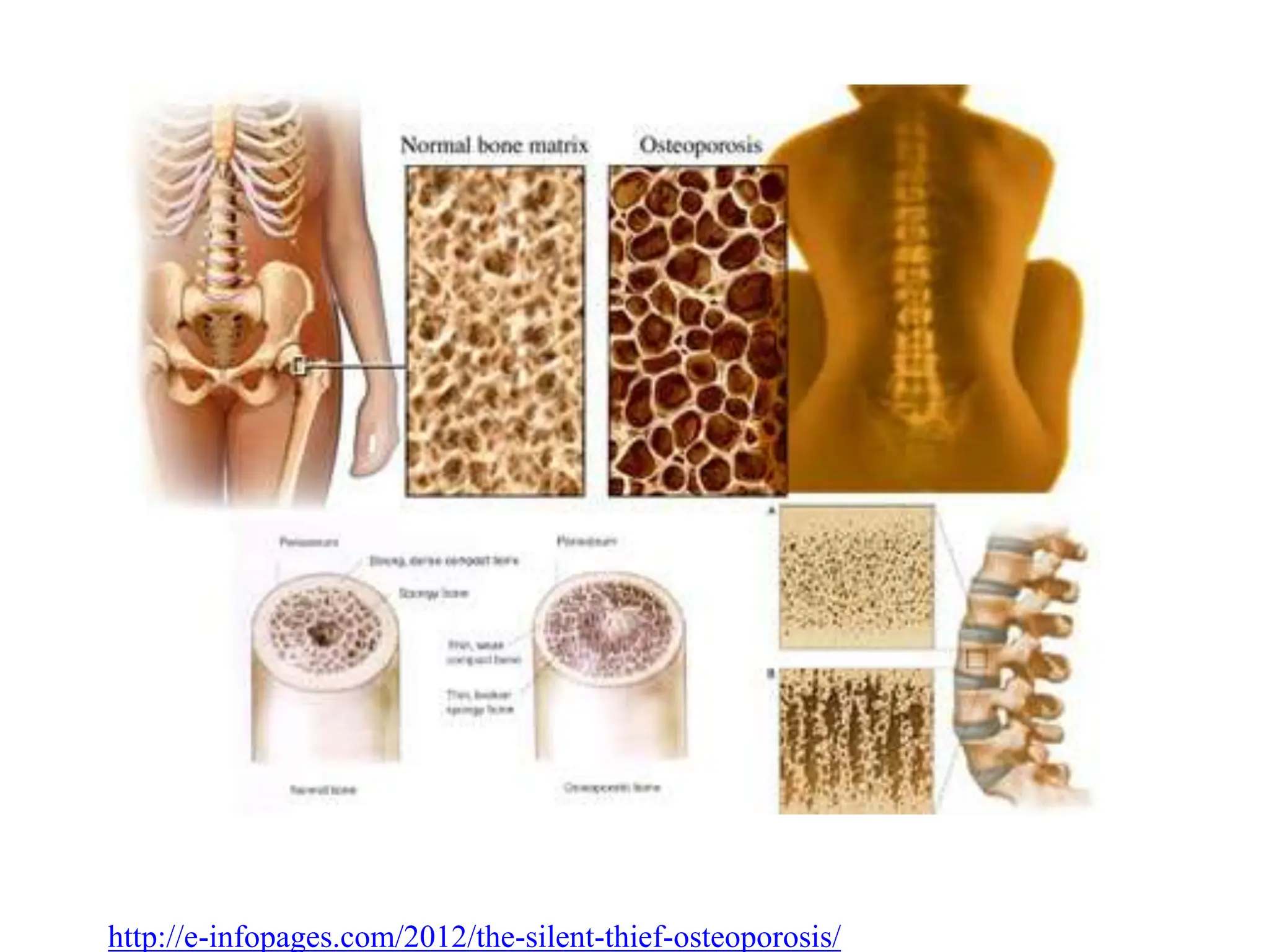 Osteoporosis in elderly causes and management | PPTX