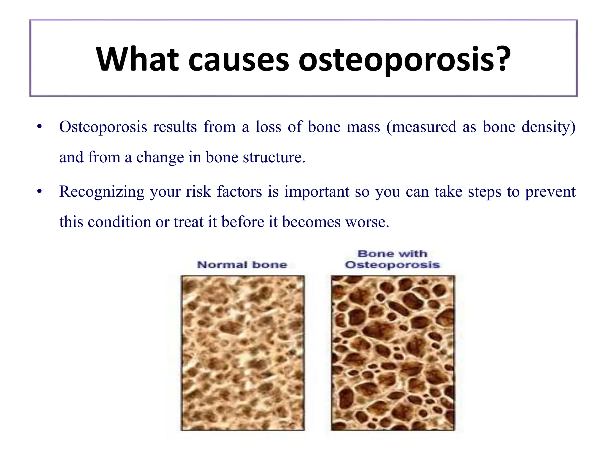 Osteoporosis in elderly causes and management | PPTX