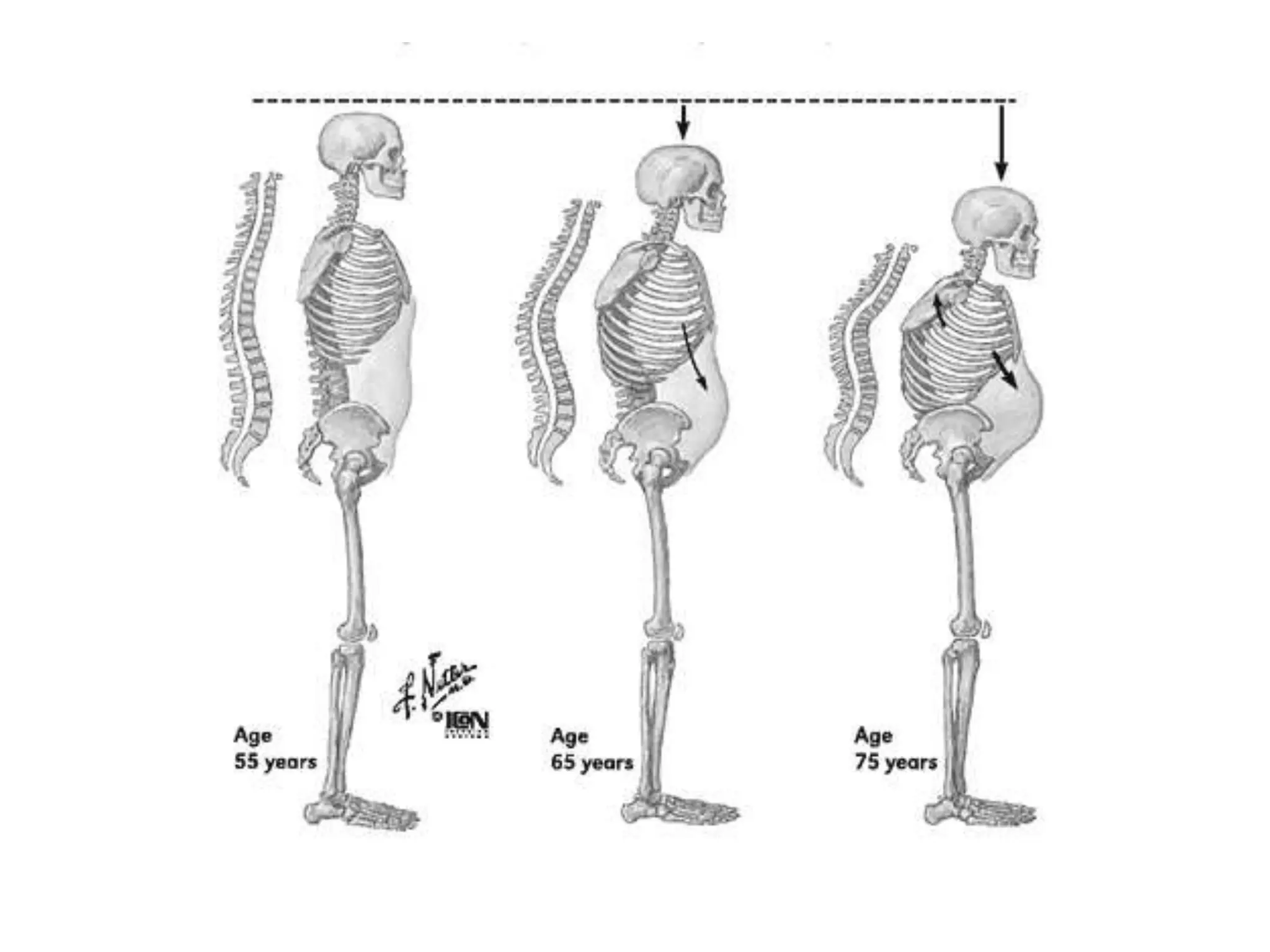 Osteoporosis in elderly causes and management | PPTX