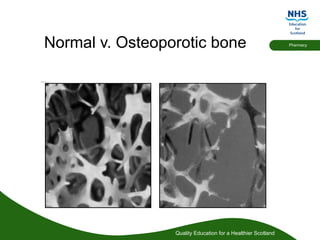 Quality Education for a Healthier Scotland
Pharmacy
Normal v. Osteoporotic bone
 