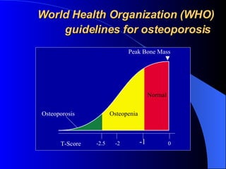 World Health Organization (WHO) guidelines for osteoporosis   Osteoporosis Osteopenia Normal Peak Bone Mass T-Score -1 -2.5 -2 0 