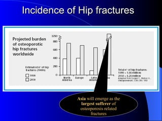 Incidence of Hip fractures Asia  will emerge as the  largest sufferer  of osteoporosis related fractures 