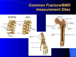 Common Fracture/BMD measurement Sites 