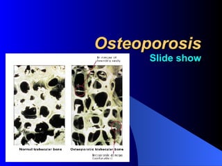 Osteoporosis Slide show 