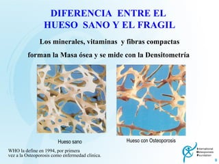 Los minerales, vitaminas  y fibras compactas forman la Masa ósea y se mide con la Densitometría  DIFERENCIA  ENTRE EL  HUESO  SANO Y EL FRAGIL WHO la define en 1994, por primera vez a la Osteoporosis como enfermedad clinica.   Hueso con Osteoporosis Hueso sano 