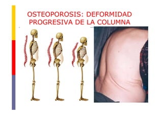 Osteoporosis.pdf 2