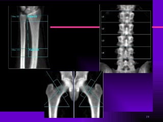Osteoporosis y Osteopenia