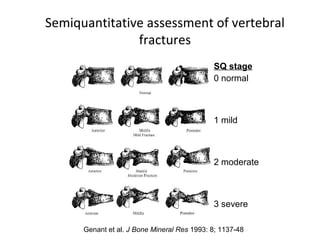 Semiquantitative assessment of vertebral
                       fractures
                                                            SQ stage
                                                            0 normal



                                                            1 mild



                                                            2 moderate



                                                            3 severe

Genant et al. J BoneGenant et al. 1993: 8;Mineral Res 1993: 8; 1137-48
                    Mineral Res J Bone 1137-48
 