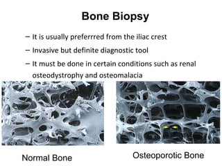 Bone Biopsy
– It is usually preferrred from the iliac crest
– Invasive but definite diagnostic tool
– It must be done in certain conditions such as renal
  osteodystrophy and osteomalacia




Normal Bone                        Osteoporotic Bone
 