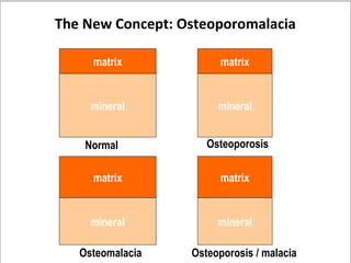 The New Concept: Osteoporomalacia

     matrix             matrix


     mineral           mineral


    Normal           Osteoporosis

     matrix             matrix


     mineral           mineral

   Osteomalacia   Osteoporosis / malacia
 