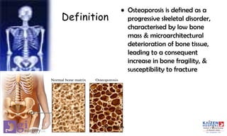 Definition
• Osteoporosis is defined as a
progressive skeletal disorder,
characterised by low bone
mass & microarchitectural
deterioration of bone tissue,
leading to a consequent
increase in bone fragility, &
susceptibility to fracture
3Osteoporosis
 
