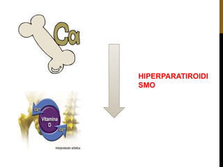 HIPERPARATIROIDI
SMO
 
