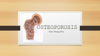 OSTEOPOROSIS
Erica Huang Hou
 