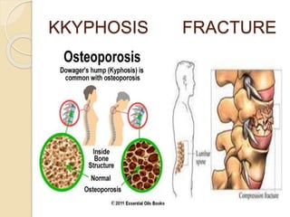 KKYPHOSIS FRACTURE
 