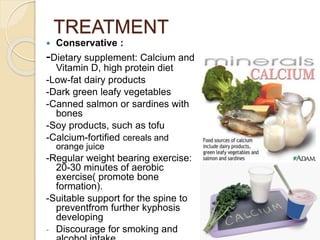 TREATMENT
 Conservative :
-Dietary supplement: Calcium and
Vitamin D, high protein diet
-Low-fat dairy products
-Dark green leafy vegetables
-Canned salmon or sardines with
bones
-Soy products, such as tofu
-Calcium-fortified cereals and
orange juice
-Regular weight bearing exercise:
20-30 minutes of aerobic
exercise( promote bone
formation).
-Suitable support for the spine to
preventfrom further kyphosis
developing
- Discourage for smoking and
 