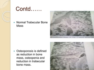 Contd……
 Normal Trabecular Bone
Mass
 Osteoporosis is defined
as reduction in bone
mass, osteopenia and
reduction in trabecular
bone mass.
 