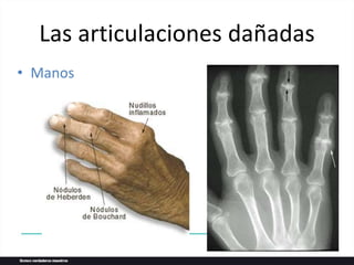 • Manos
Las articulaciones dañadas
 