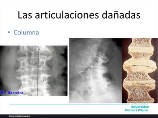 • Columna
Las articulaciones dañadas
 