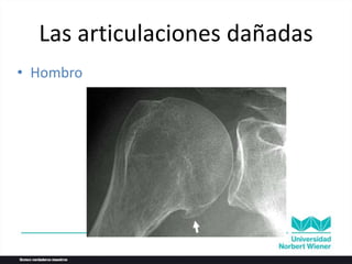 • Hombro
Las articulaciones dañadas
 