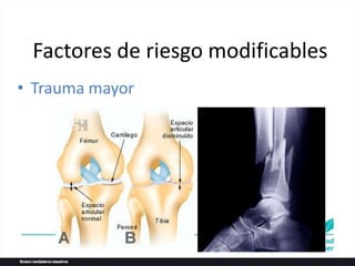 • Trauma mayor
Factores de riesgo modificables
 
