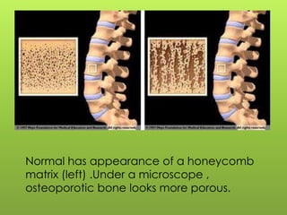 Normal has appearance of a honeycomb
matrix (left) .Under a microscope ,
osteoporotic bone looks more porous.

 