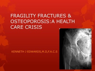FRAGILITY FRACTURES &
OSTEOPOROSIS:A HEALTH
CARE CRISIS
KENNETH J EDWARDS,M.D,F.A.C.S
 