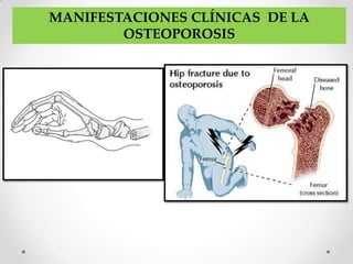 MANIFESTACIONES CLÍNICAS DE LA
        OSTEOPOROSIS
 