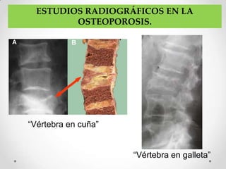 ESTUDIOS RADIOGRÁFICOS EN LA
         OSTEOPOROSIS.




“Vértebra en cuña”


                     “Vértebra en galleta”
 