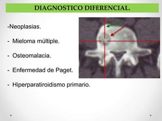 DIAGNOSTICO DIFERENCIAL.

-Neoplasias.

- Mieloma múltiple.

- Osteomalacia.

- Enfermedad de Paget.

- Hiperparatiroidismo primario.
 