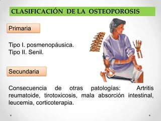 CLASIFICACIÓN DE LA OSTEOPOROSIS

Primaria

Tipo I. posmenopáusica.
Tipo II. Senil.


Secundaria

Consecuencia de otras patologías:             Artritis
reumatoide, tirotoxicosis, mala absorción intestinal,
leucemia, corticoterapia.
 