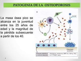 PATOGENIA DE LA OSTEOPOROSIS



La masa ósea pico se
alcanza en la juventud
entre los 25 años de
edad y la magnitud de
la pérdida subsecuente
a partir de los 40.
 