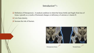Introduction(1):-
 Definition of Osteoporosis:- A medical condition in which the bones brittle and fragile from loss of
tissue, typically as a results of hormonal changes or deficiency of calcium or vitamin D.
 Low bone density.
 Increase the risk of fracture.
Osteoporosis bones Normal bones
 