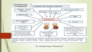 Fig:- Pathophysiology of Osteoporosis(3)
 