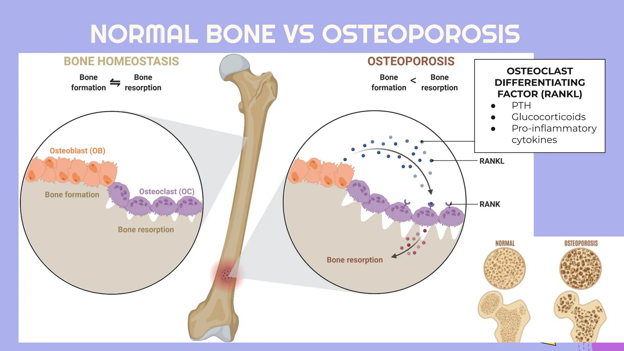OSTEOPOROSIS & FRACTURE FRAGILITY-1.pdftvtvtvtvtv | PDF