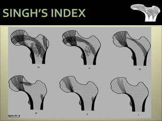 SINGH’S INDEX
 