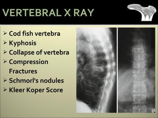 Cod fish vertebra
 Kyphosis
 Collapse of vertebra
 Compression
Fractures
 Schmorl's nodules
 Kleer Koper Score
VERTEBRAL X RAY
 