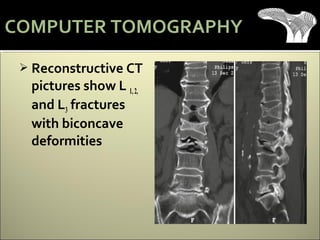  Reconstructive CT
pictures show L 1,2,
and L3 fractures
with biconcave
deformities
COMPUTER TOMOGRAPHY
 
