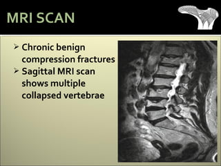  Chronic benign
compression fractures
 Sagittal MRI scan
shows multiple
collapsed vertebrae
MRI SCAN
 