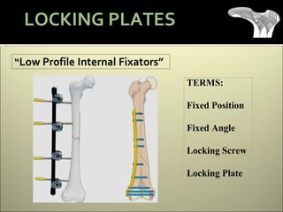 TERMS:
Fixed Position
Fixed Angle
Locking Screw
Locking Plate
LOCKING PLATES
 