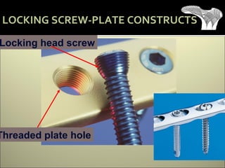 LOCKING SCREW-PLATE CONSTRUCTS
Locking head screw
Threaded plate hole
 