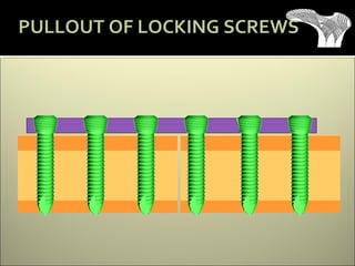 PULLOUT OF LOCKING SCREWS
 