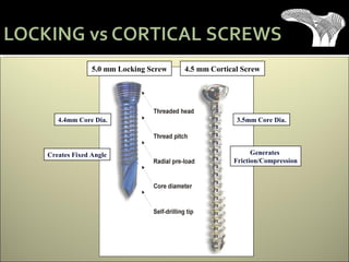 Creates Fixed Angle Generates
Friction/Compression
4.4mm Core Dia. 3.5mm Core Dia.
5.0 mm Locking Screw 4.5 mm Cortical Screw
 