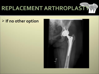  If no other option
REPLACEMENT ARTHROPLASTY
 