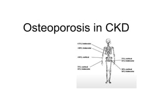 Osteoporosis Disease in Chronic Kidney Diseases | PPTX