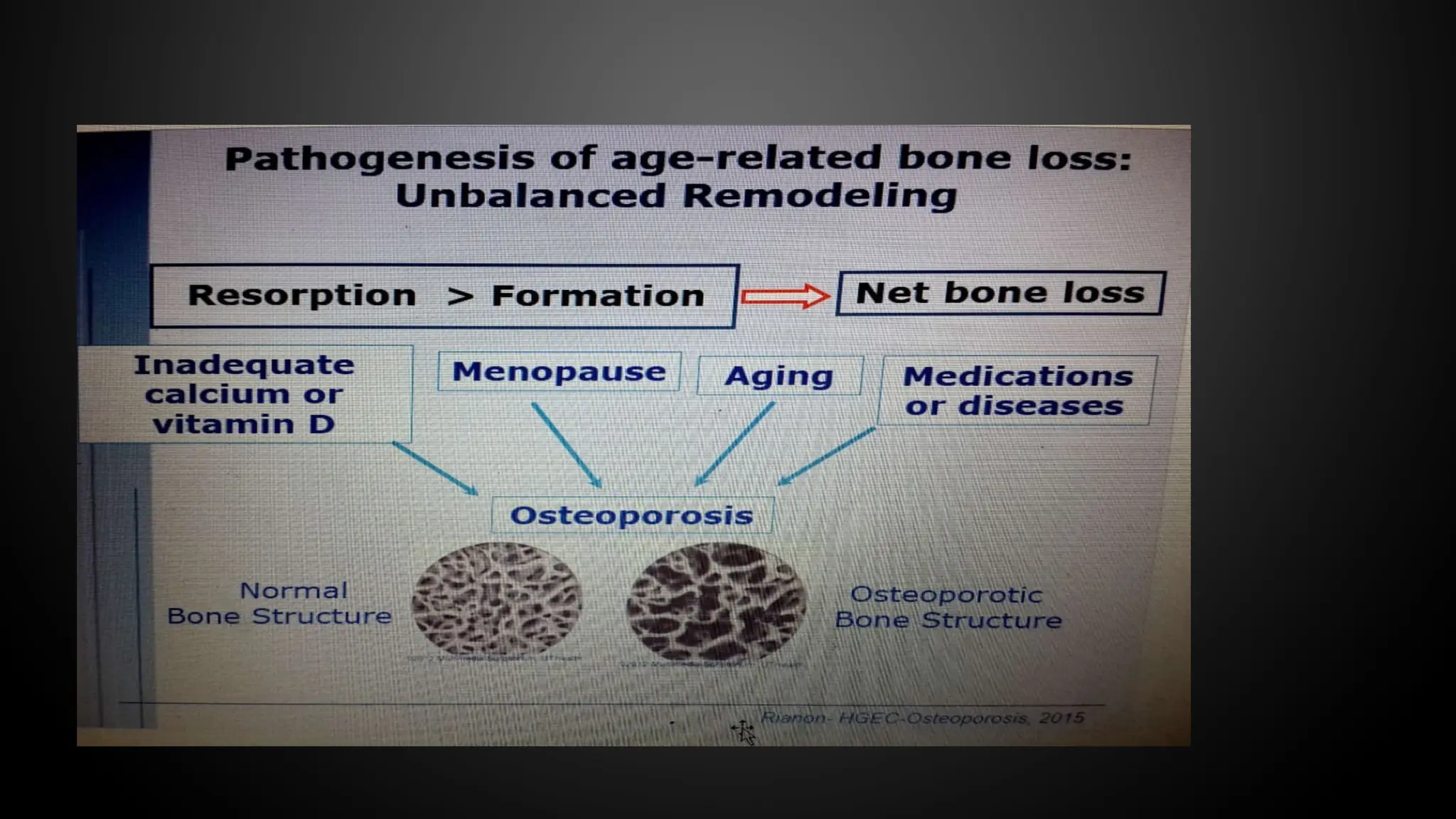 Etiology of Osteoporosis in elderly.pptx