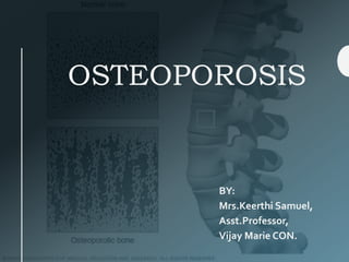 OSTEOPOROSIS
BY:
Mrs.Keerthi Samuel,
Asst.Professor,
Vijay Marie CON.
 