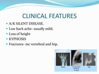 CLINICAL FEATURES
 A/K SILENT DISEASE.
 Low back ache- usually mild.
 Loss of height
 KYPHOSIS
 Fractures- mc vertebral and hip.
 