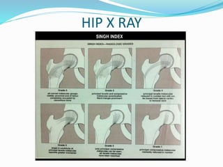 HIP X RAY
 