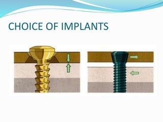 CHOICE OF IMPLANTS
 