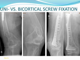 UNI- VS. BICORTICAL SCREW FIXATION
female
Slide 85
 